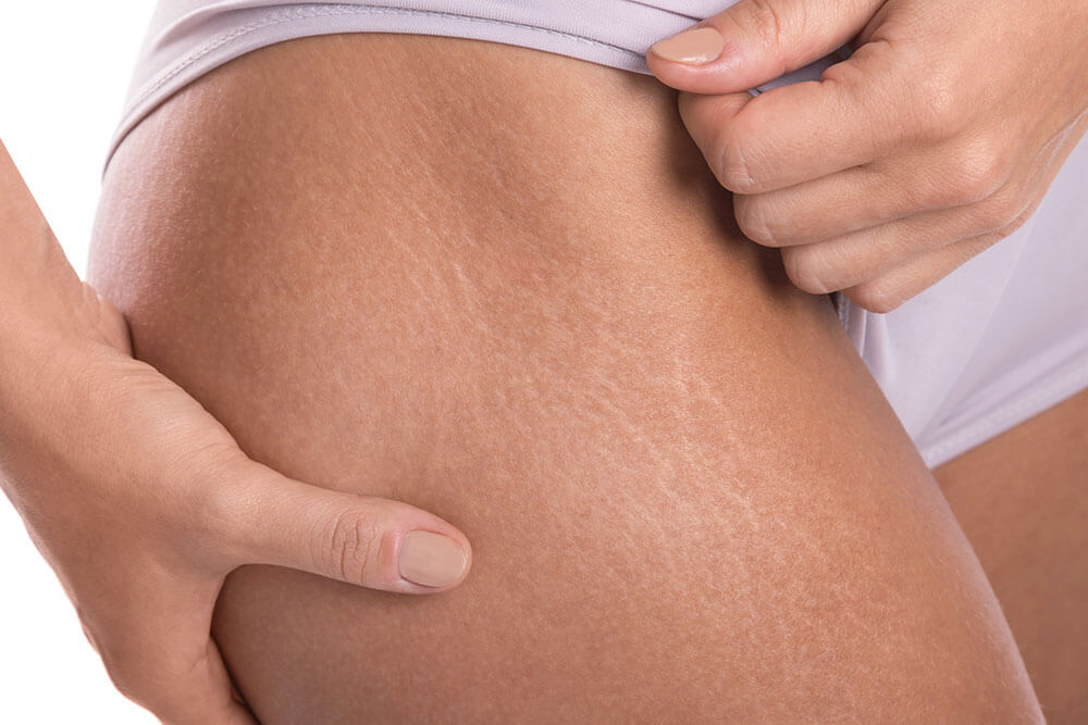 courses Dealing with Stretch Marks